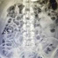 خارج کردن جسم فلزی از مری بیمار بدون جراحی باز