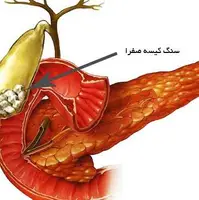 غذای فوق العادهای که سنگ کیسه صفرا را دفع میکند