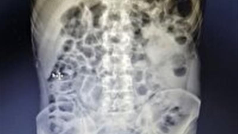 خارج کردن جسم فلزی از مری بیمار بدون جراحی باز