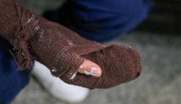 انگشتان پسر ۱۶ ساله اصفهانی، قربانی جدید ترقهبازی