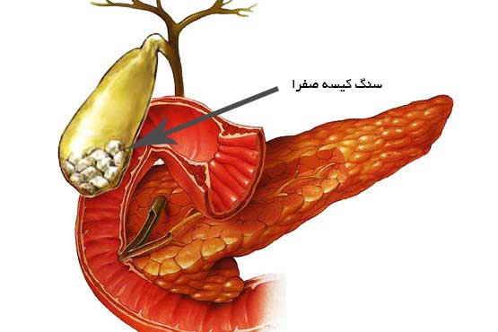 غذای فوق العادهای که سنگ کیسه صفرا را دفع میکند