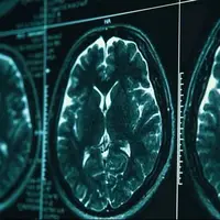 روشی در توقف بیماری آلزایمر کشف شد