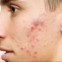 دلیل ایجاد جوش بعد از بلوغ چیست؟