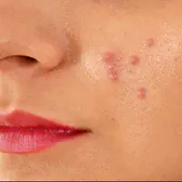 دلایلی که باعث ایجاد جوش در پوست می‌شود