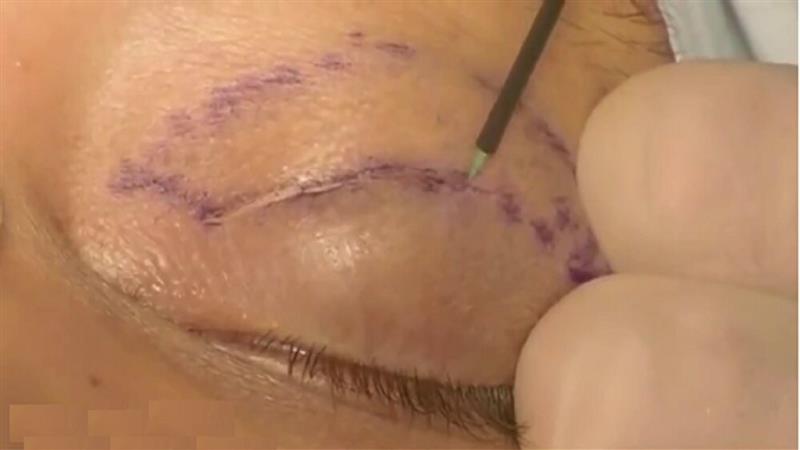 استادیار دانشگاه علومپزشکی اصفهان:بلفاروپلاستی ظاهر چشم را تغییر نمیدهد؛ فقط جوانتر میکند