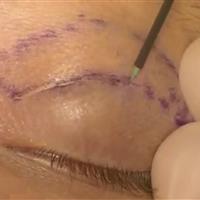 استادیار دانشگاه علوم‌پزشکی اصفهان:بلفاروپلاستی ظاهر چشم را تغییر نمی‌دهد؛ فقط جوان‌تر می‌کند