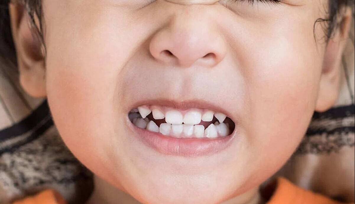 راز دندان قروچه در خواب که هیچکس نمیگوید؛ چطور کنترل کنیم؟