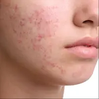 قوی ترین نسخه ضد اکنه صورت!