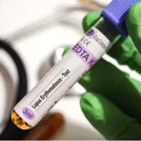 کشف قوی‌ترین شواهد از نقش ویروس اپشتین بار در بروز بیماری لوپوس