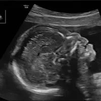 آیا تشخیص زودهنگام «سندرم داون» با شاخص استخوان بینی ممکن است؟