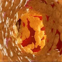 کاهش ۵۸ درصدی کلسترول بد با یک داروی جدید