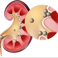 بهترین راهکار برای مبتلا نشدن به سنگ کلیه