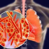 بیماری انسدادی مزمن ریه چهارمین علت مرگ‌ومیر جهان است