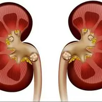 شایع‌ترین دلیل ایجاد سنگ کلیه رسوب املاح در کلیه است