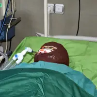 اسیدپاشی هولناک روی پدر و دختر نوجوان