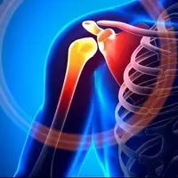 شانه یخ‌زده چیست؟