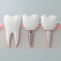 قیمت ایمپلنت دندان 1404 + شرایط اقساطی در شرق تهران