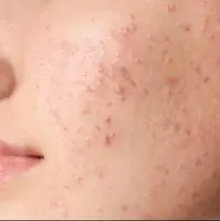 نسخه شخصی دکتر برای درمان جوش!