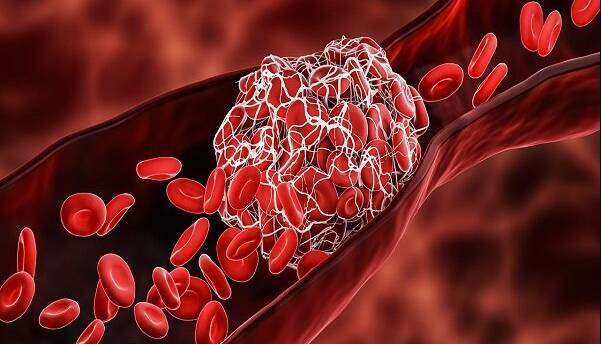 چربی خون بالا؛ دشمن خاموش رگها