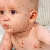 باید و نبایدهای دوره ابتلا به آبله مرغان