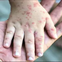 هشدار سازمان جهانی بهداشت؛ شیوع جهانی سرخک با سرعت