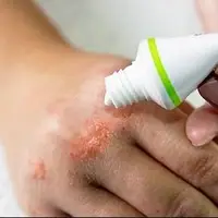 آلرژیهای ناشی از محصولات آرایشی، چالشی جدی اما قابل پیشگیری