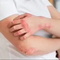 آشنایی با علائم بیماری پسوریازیس