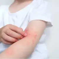 روش درمانی جدید برای بیماری پسوریازیس