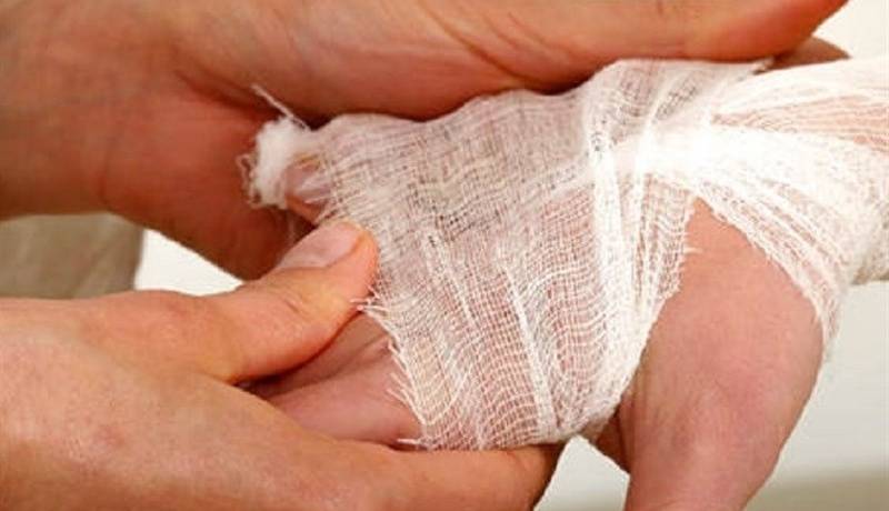 بستری سالانه 30هزار نفر بر اثر سوختگی در کشور