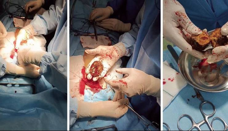 ماجرای وحشتناک «خرمالو» در اتاق های عمل!