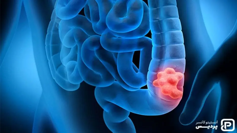 چطور جلوی سرطان روده را بگیریم؟