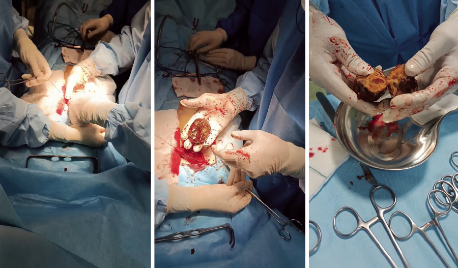 ماجرای وحشتناک «خرمالو با پوست»؛ بستری شدن ۶ بیمار طی ۳ هفته فقط در یک بیمارستان مشهد!