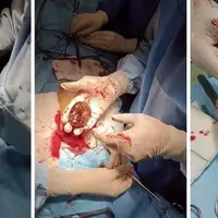 ماجرای وحشتناک «خرمالو» در اتاق های عمل!