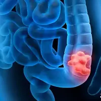 چطور جلوی سرطان روده را بگیریم؟