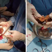 حاوی تصاویر دلخراش؛ بیرون کشیدن خرمالو از شکم یک بیمار!