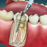 بعد از عصبکشی عفونت برمیگردد؟!