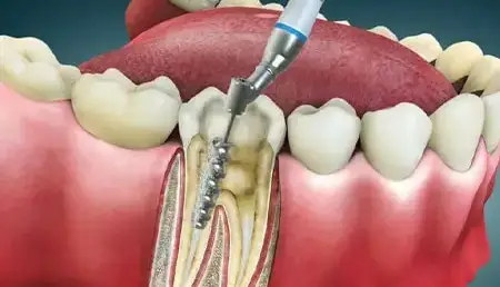 بعد از عصبکشی عفونت برمیگردد؟!