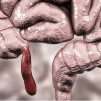 پژوهشگران از افزایش شیوع سرطانی نادر در جوانان خبر میدهند