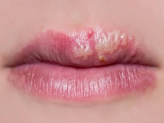 هیچ درمان کاملی برای تبخال وجود ندارد!