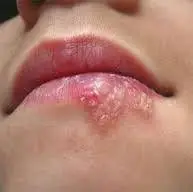 تبخال یک ویروس است که در بدن میماند