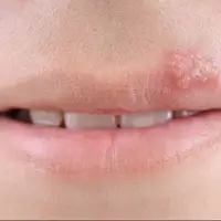 راههای درمانی خانگی اشتباه برای از بین بردن تبخال