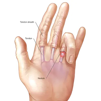 درمان انگشت ماشه ای چگونه است؟