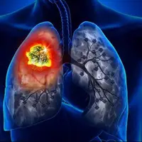 سختیها و ملاحظاتی که برای جراحی ریه باید انجام شود