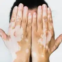 روشی برای درمان پیسی پوست