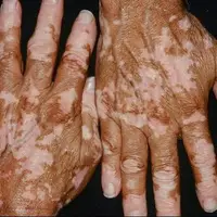 استرس باعث افزایش پیسی میشود؟