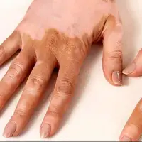 تعریفی از بیماری پیسی پوست