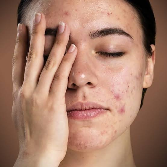 چه عواملی باعث ایجاد جوش می‌شود؟