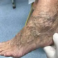 چه عواملی باعث بیماری واریس در یک فرد میشود؟