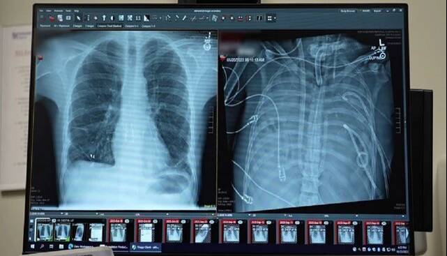 مردی ۴۸ ساعت بدون ریه زنده ماند!