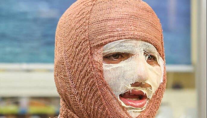 آیا بهبود کامل پس از سوختگیهای عمیق امکانپذیر است؟